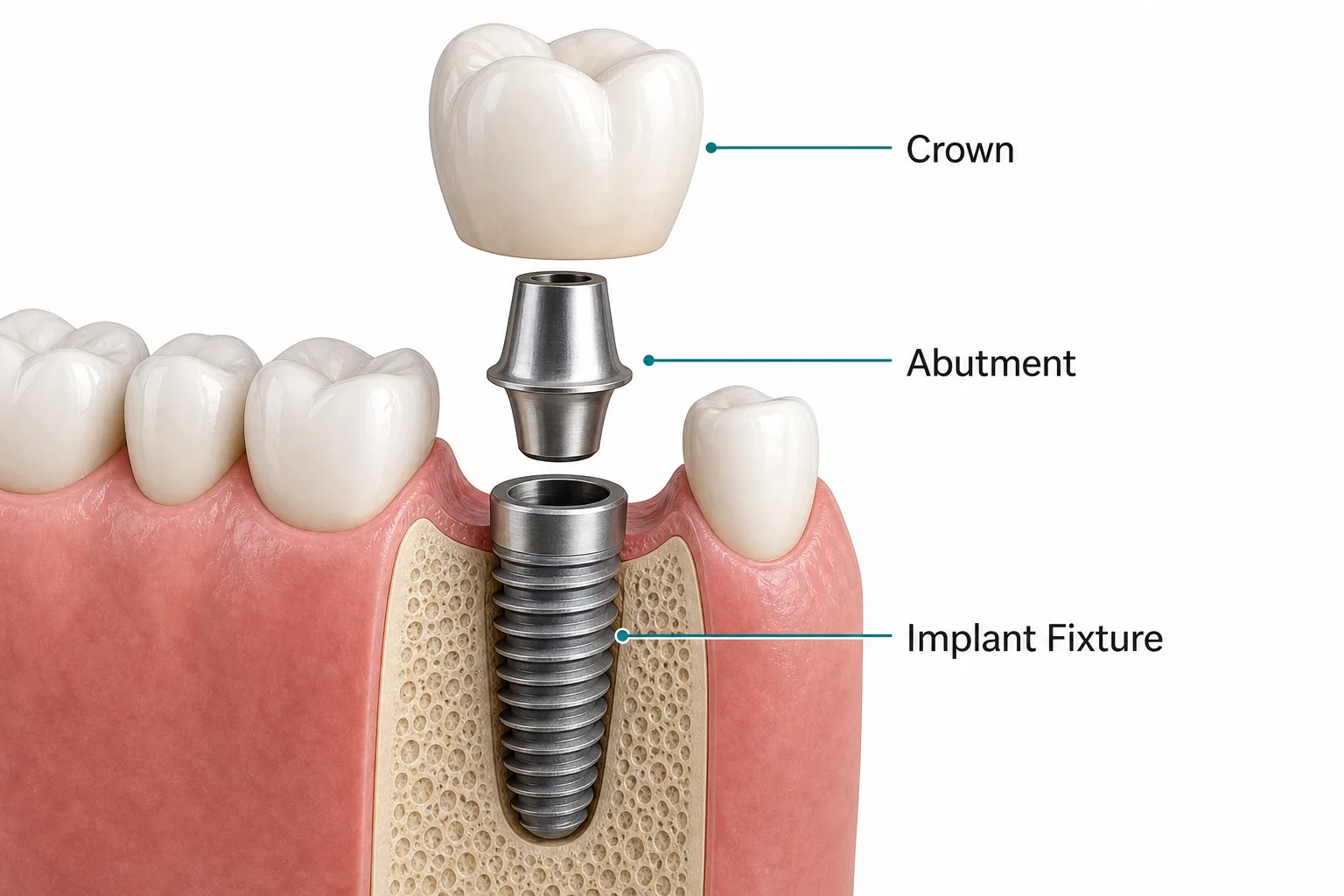 اجزای ایمپلنت به انگلیسی شامل Implant Fixture، Abutment و Crown